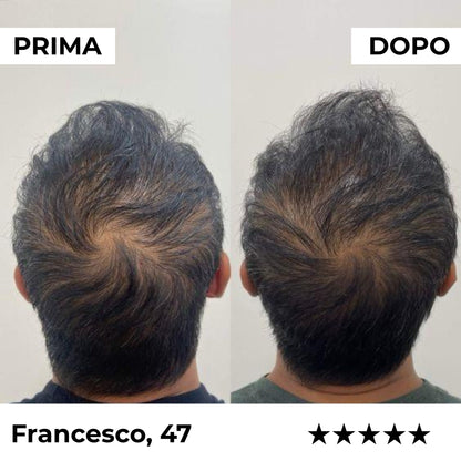 Sistema di microinfusione Firmelià® per la ricrescita dei capelli