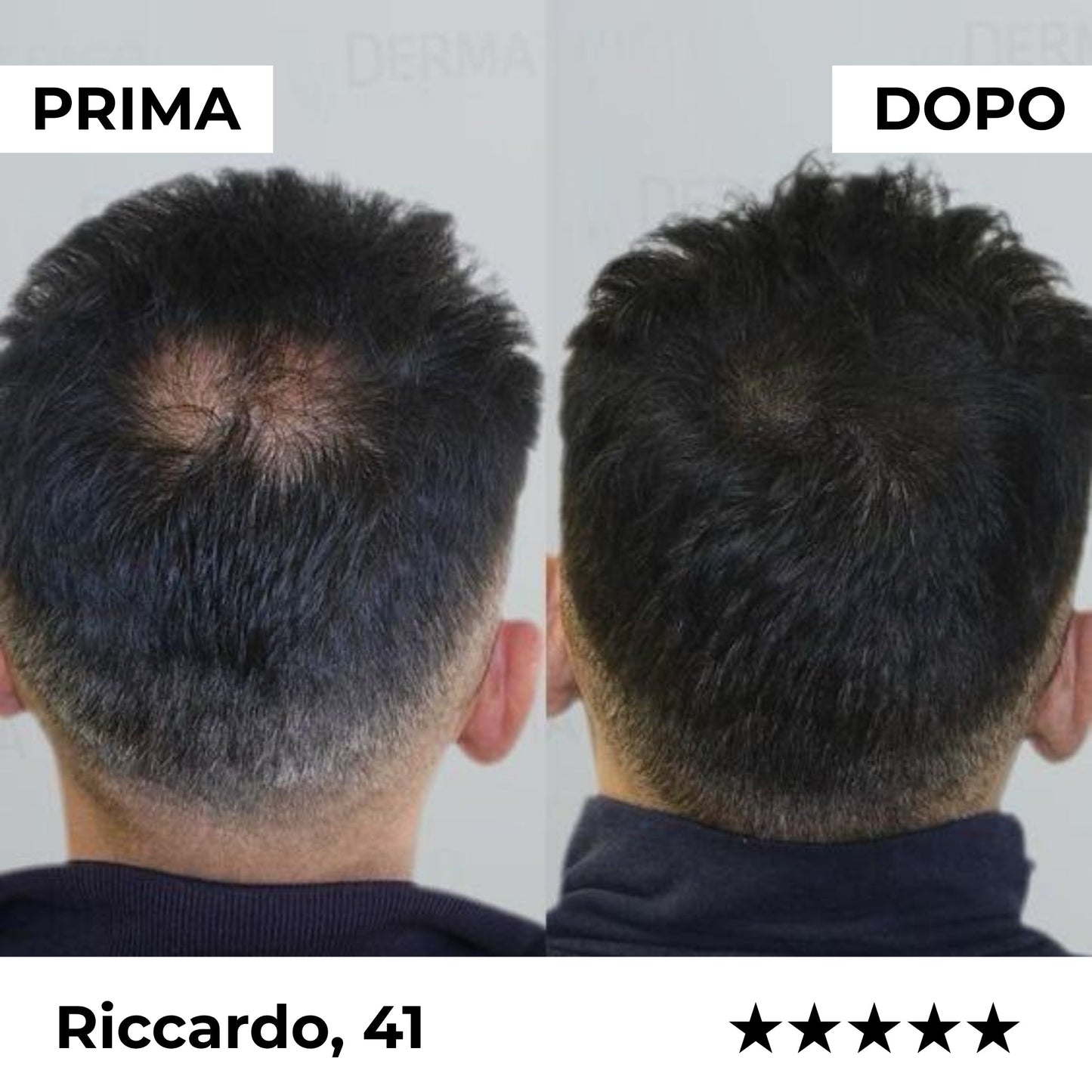 Sistema di microinfusione Firmelià® per la ricrescita dei capelli