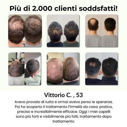 Sistema di microinfusione Firmelià® per la ricrescita dei capelli